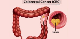 పెద్దపేగు క్యాన్సర్: లక్షణాలు.. చికిత్స.. జాగ్రత్తలు Colon Cancer Symptoms