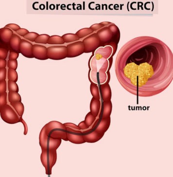 పెద్దపేగు క్యాన్సర్: లక్షణాలు.. చికిత్స.. జాగ్రత్తలు Colon Cancer Symptoms