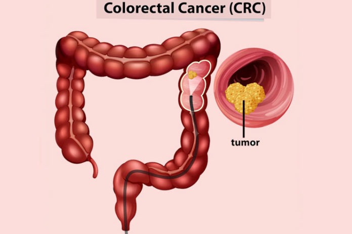 Colon Cancer Symptoms