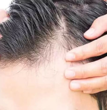 బట్టతల: జట్టు రాలుతోందా.? త్వరగా గుర్తించండీ.. చికిత్స అందించండి Why Do Men Go Bald