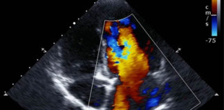 ఎకోకార్డియోగ్రఫీ అంటే ఏమిటీ?: దీనిని వైద్యులు ఎందుకు సూచిస్తారు? Echocardiagram Purpose