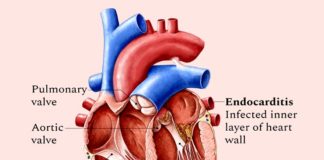 ఎండోకార్డిటీస్ అంటే ఏమిటీ?: లక్షణాలు, కారకాలు, నిర్థారణ, చికిత్స Endocarditis Symptoms