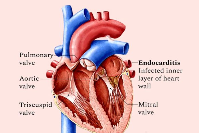 Endocarditis Symptoms