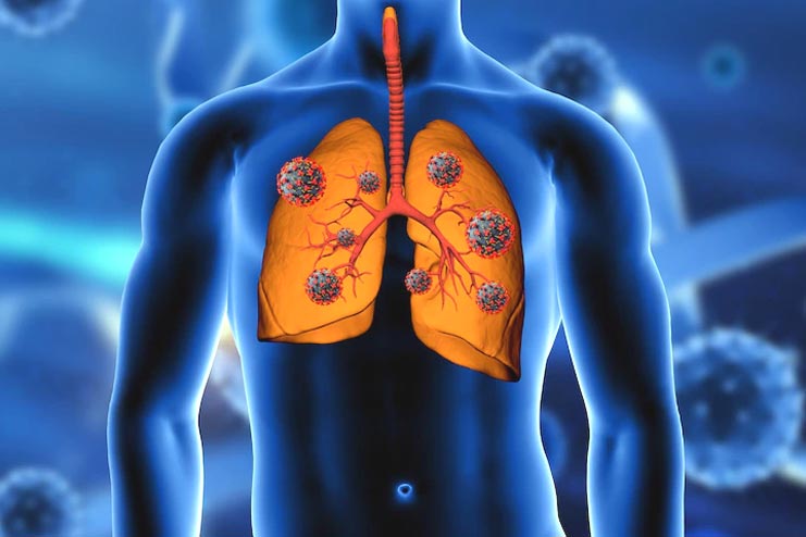 Lungs Infections Deadly Viruses