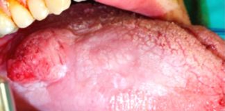 నాలుక క్యాన్సర్: లక్షణాలు, కారకాలు, చికిత్స Tongue Cancer