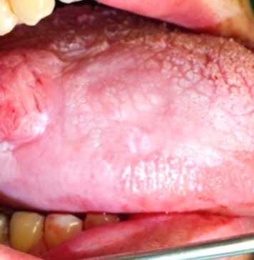 నాలుక క్యాన్సర్: లక్షణాలు, కారకాలు, చికిత్స Tongue Cancer