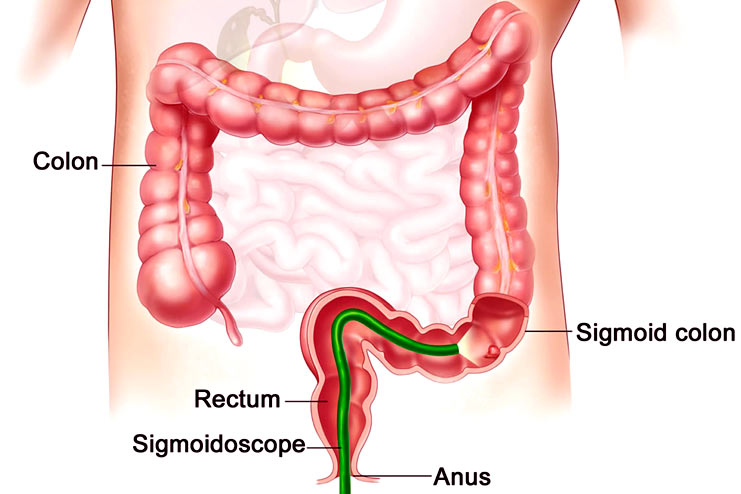 Colonoscopy who needs