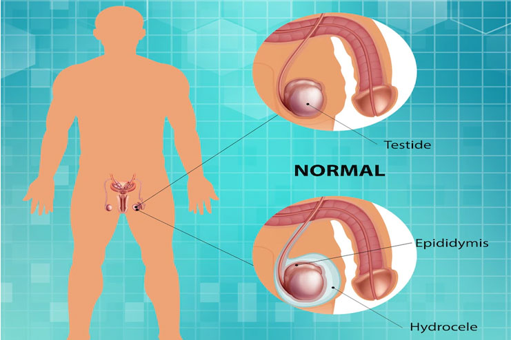 Hydrocele Causes