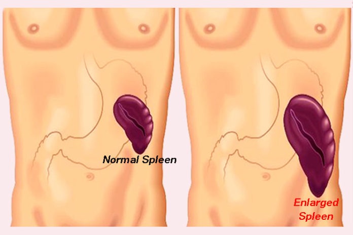 Enlarged Spleen Splenomegaly