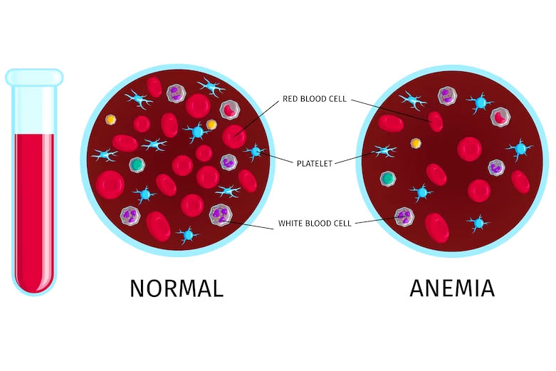 Iron deficiency anemia