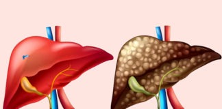 లీవర్ సిర్రోసిస్: కారకాలు, గుర్తింపు, దశలు, చికిత్స - Liver Cirrhosis: Symptoms, causes and Treatment in Telugu Liver Cirrhosis