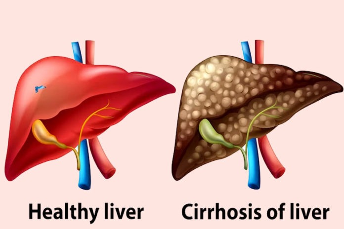 Liver Cirrhosis