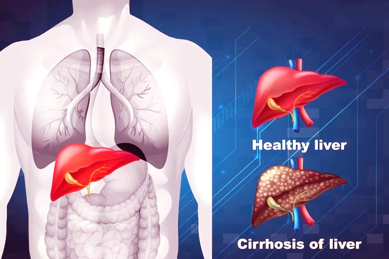 Liver Cirrhosis Treatment