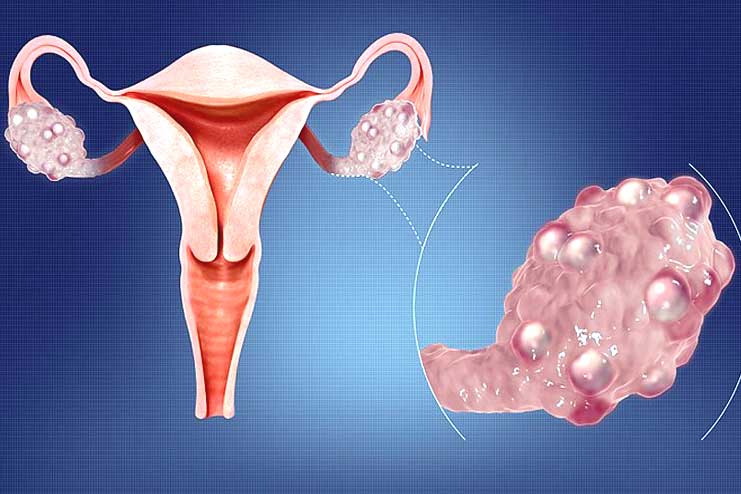 Polycystic ovarian syndrome PCOS