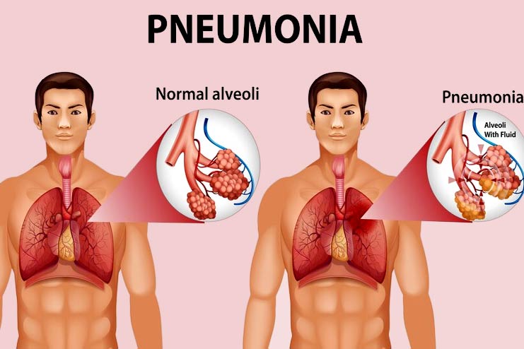 Types of pneumonia