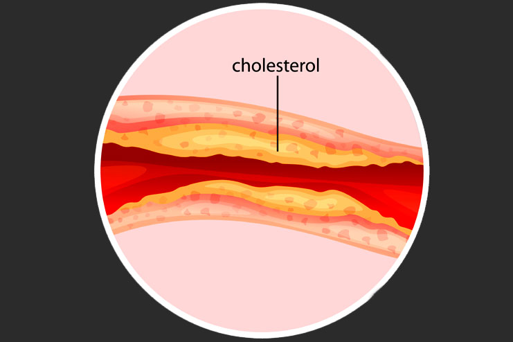 Carotid artery disease causes and risk factors