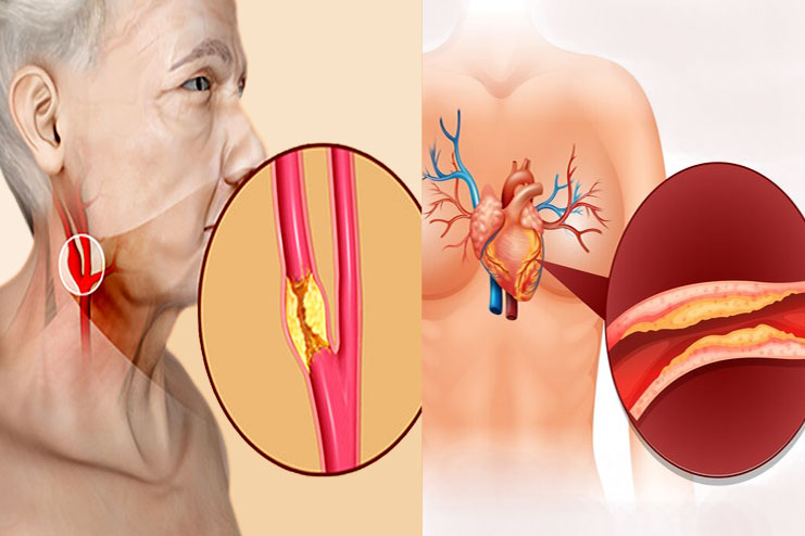 Carotid vs. coronary artery disease