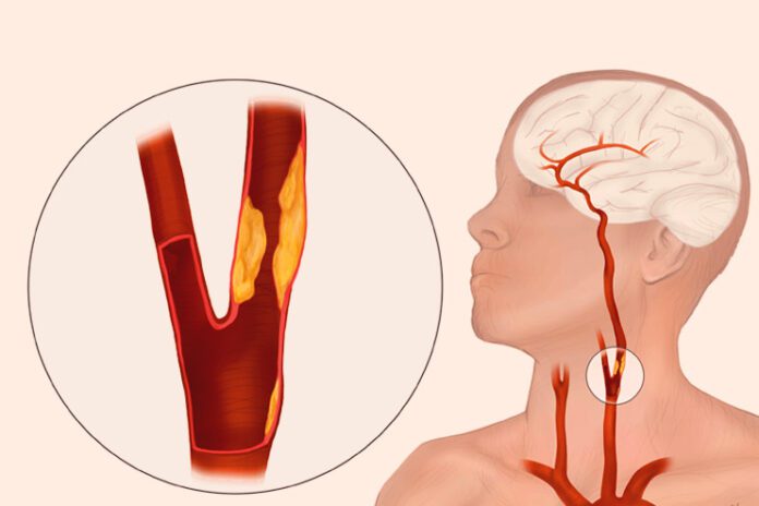 Mysteries of Carotid Artery Disease