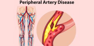 పెరిఫెరల్ ఆర్టరీ డిసీజ్: లక్షణాలు, కారణాలు, చికిత్స - Peripheral artery disease: Symptoms, causes, Treatment Peripheral Artery Disease