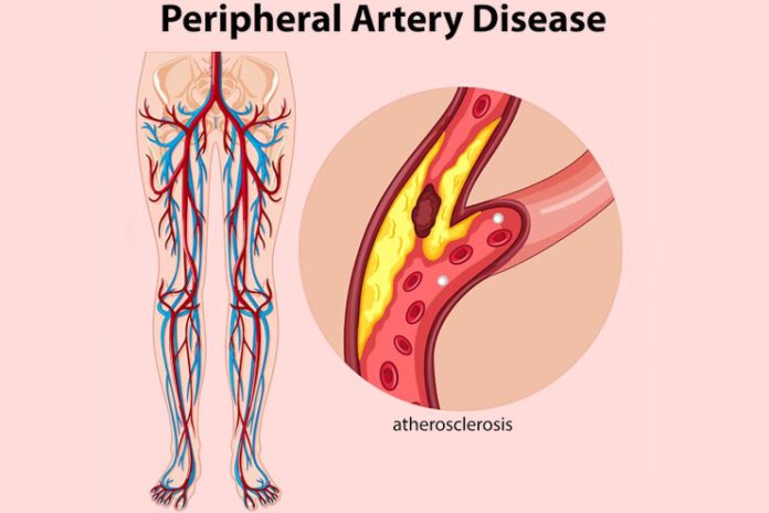 Peripheral Artery Disease