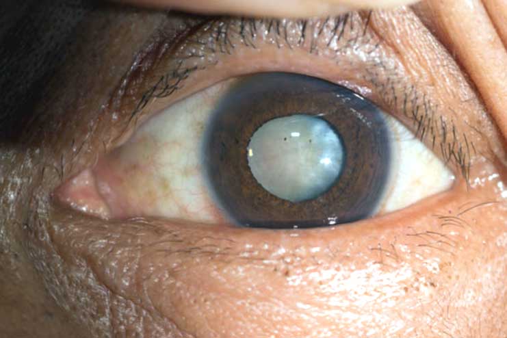 Cataract