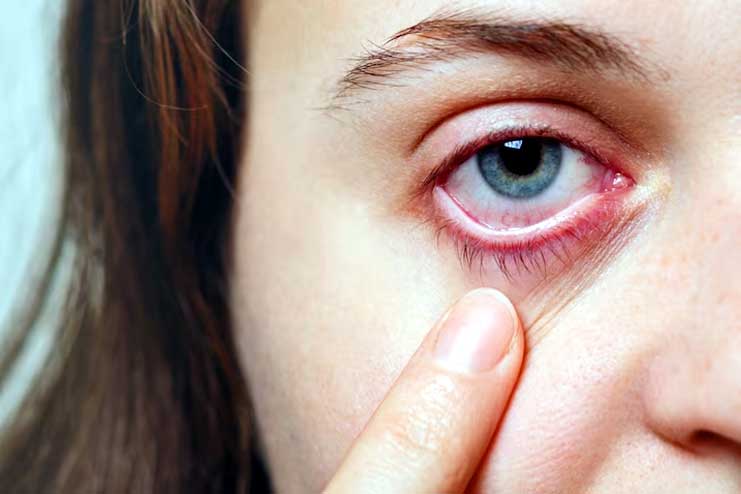 Conjunctivitis