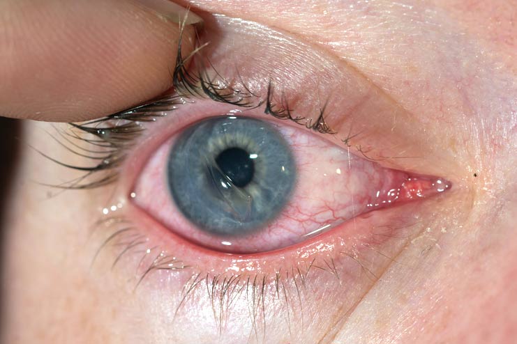 Corneal abrasion