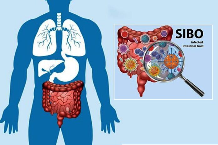 Demystifying SIBO