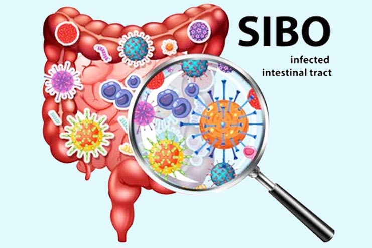 SIBO Causes