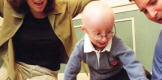 ప్రొజెరియా: కారణాలు, లక్షణాలు మరియు చికిత్స - What Is Progeria: Causes, Symptoms, and Treatment Progeria