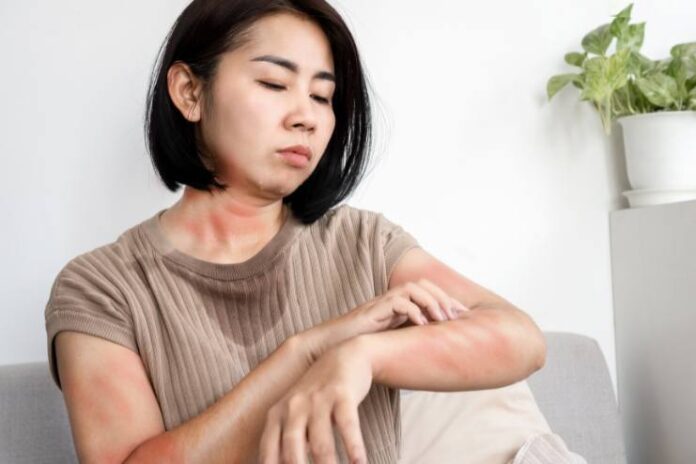 Winter Skin Diseases