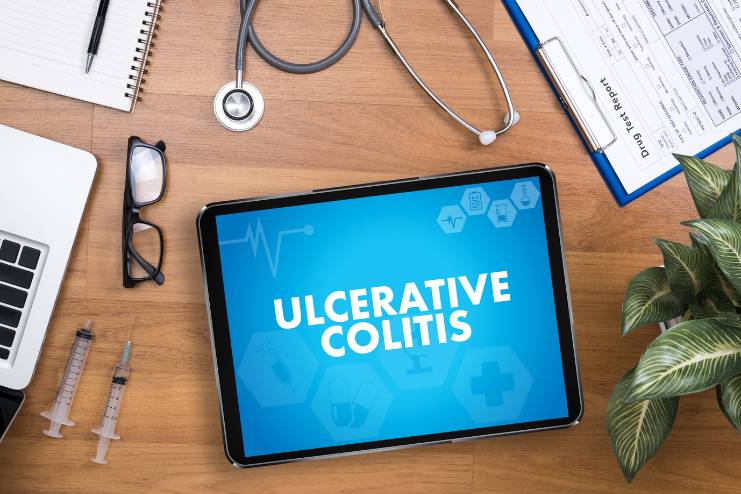 Diagnosis of Ulcerative colitis