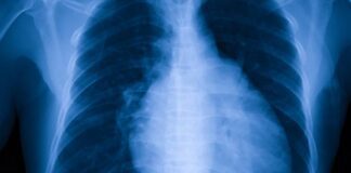 కార్డియోమెగలీ అంటే ఏమిటీ? కారకాలు, చికిత్స, ఇంకా - Cardiomegaly (Enlarged Heart): Causes, Treatment, and More Cardiomegaly Enlarged Heart