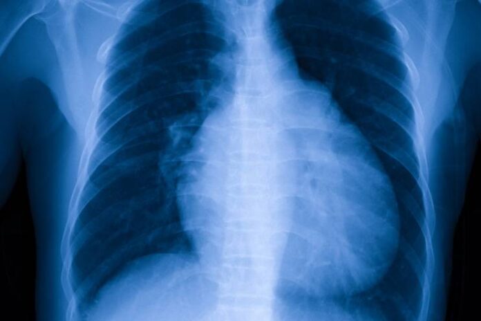 Cardiomegaly Enlarged Heart