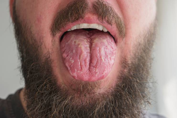 Geographic Tongue