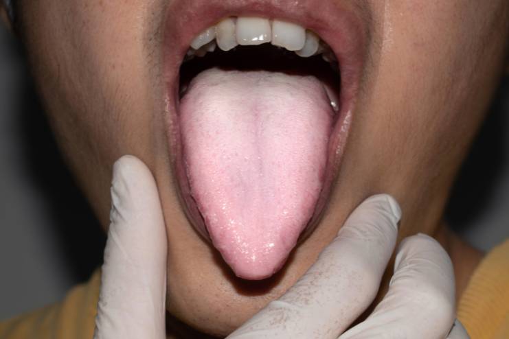 Leukoplakia