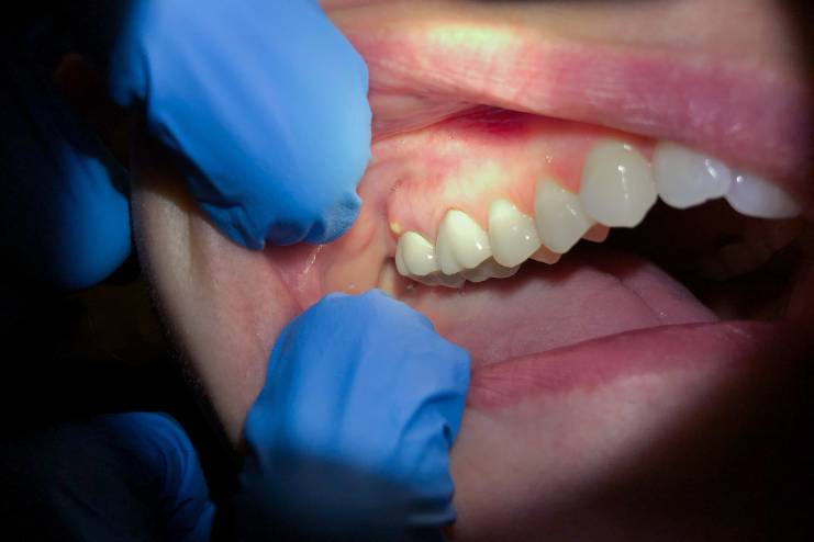 Tooth Abscesses