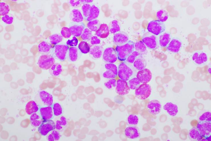 How does leukaemia affect children