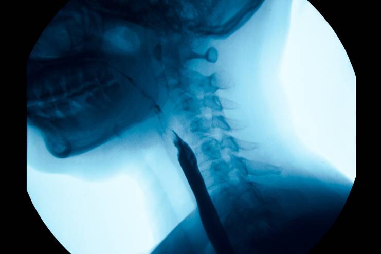 How to diagnose Achalasia Cardia