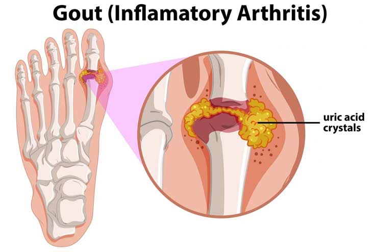 Symptoms of a gout attack