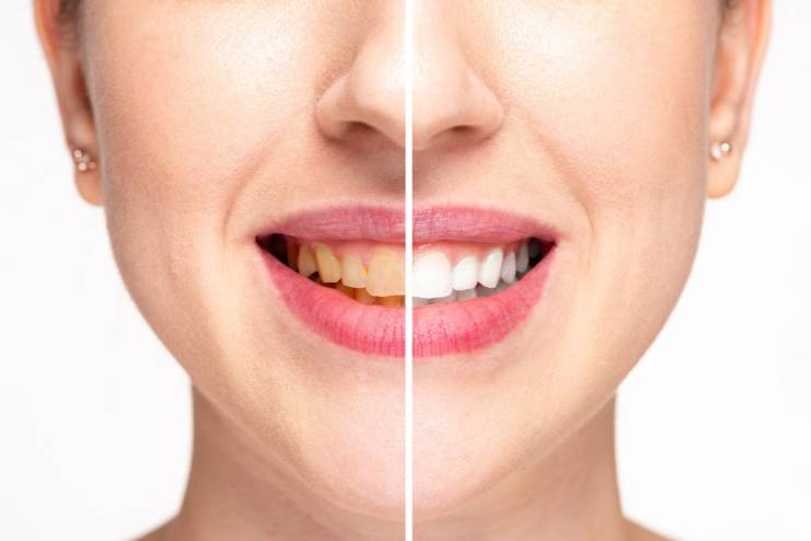 Tips to Whiten Your Teeth Instantly