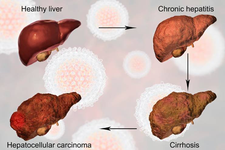 Treatment For Liver Cirrhosis