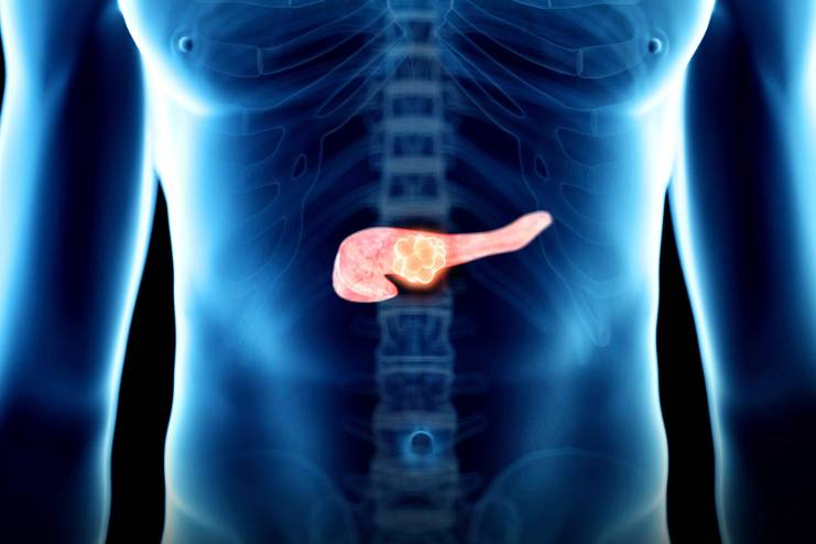 What are the types of pancreatitis