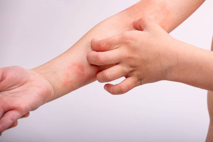 Atopic dermatitis