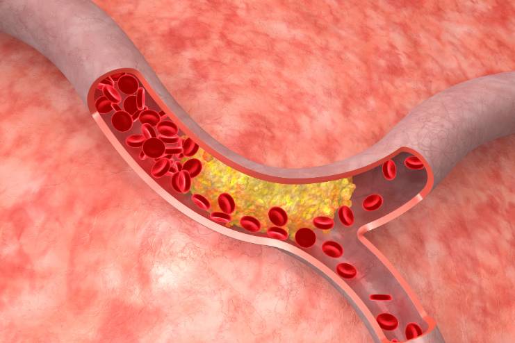 Cholesterol levels