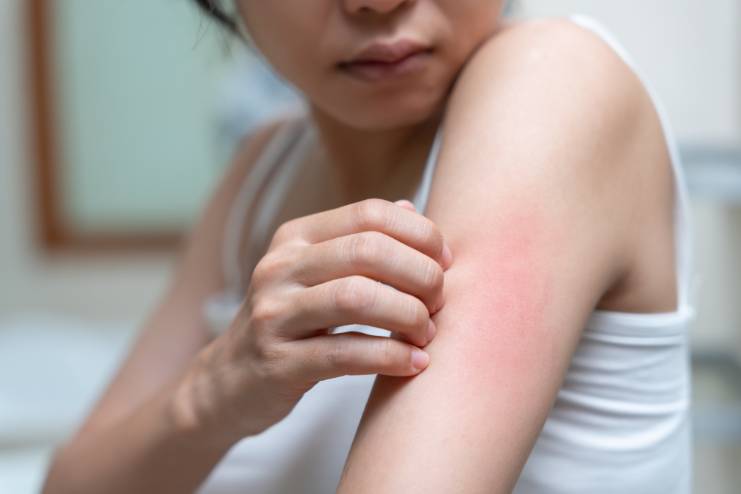 Prickly heat or heat rash or Miliaria Rubra