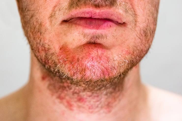 Seborrheic dermatitis