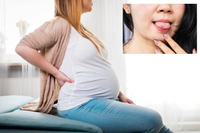 Tongue Sores During Pregnancy