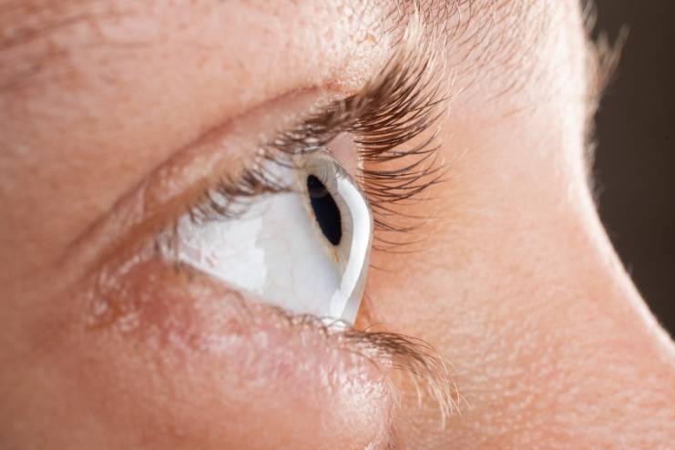 What is Keratoconus