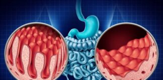 ఉదరకుహర వ్యాధి గురించి తెలుసుకోవాల్సిన అంశాలు - Celiac Disease: Key Facts You Need to Know Celiac Disease